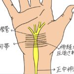 手根管で正中神経が圧迫される仕組みを示したイラスト