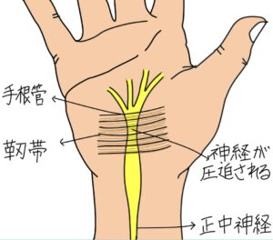 手根管で正中神経が圧迫される仕組みを示したイラスト