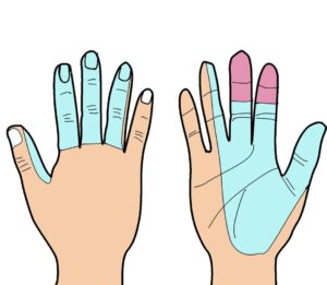 手根管症候群でしびれが出やすい手や指の範囲を示したイラスト