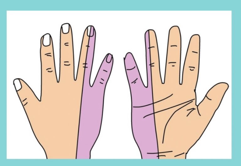 肘部管症候群でしびれが出やすい小指と薬指の範囲を示したイラスト